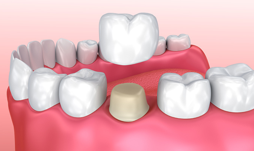 Restore Your Smile With Same-Day Dental Crowns