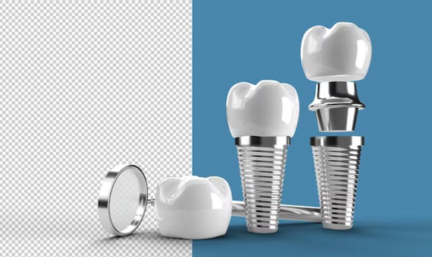 Dental Implant In the Simple Tooth - Dentist Foothill Ranch CA