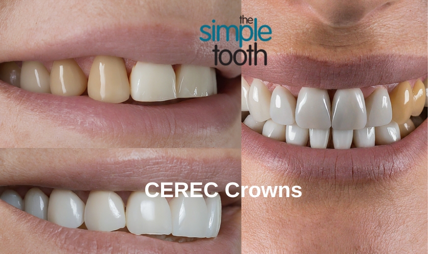 Pros and Cons of CEREC Dental Crowns