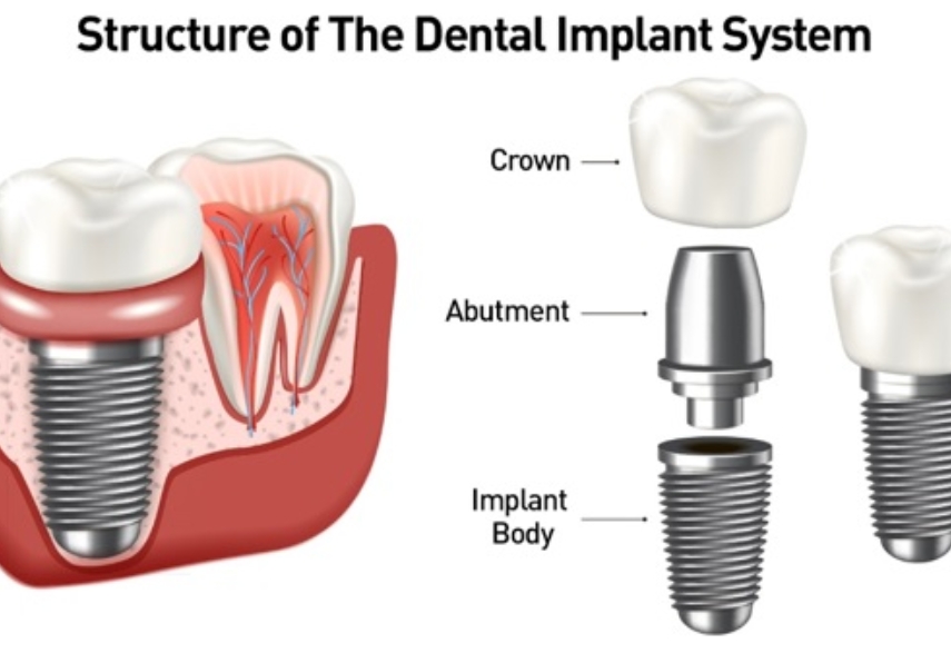 how can dental implants improve your quality of life in foothill ranch