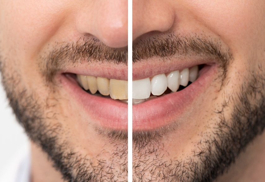 teeth whitening options for smokers