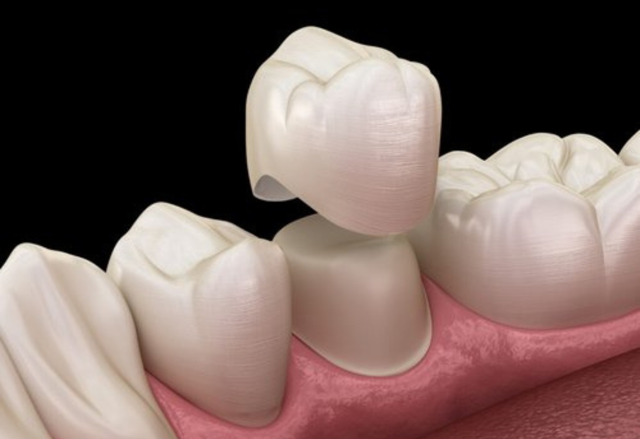 Why And How A Dental Crown Is Removed? A Detailed Guide