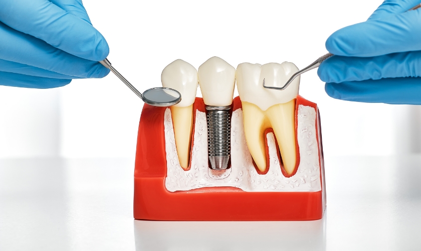 dental implants in Foothill Ranch