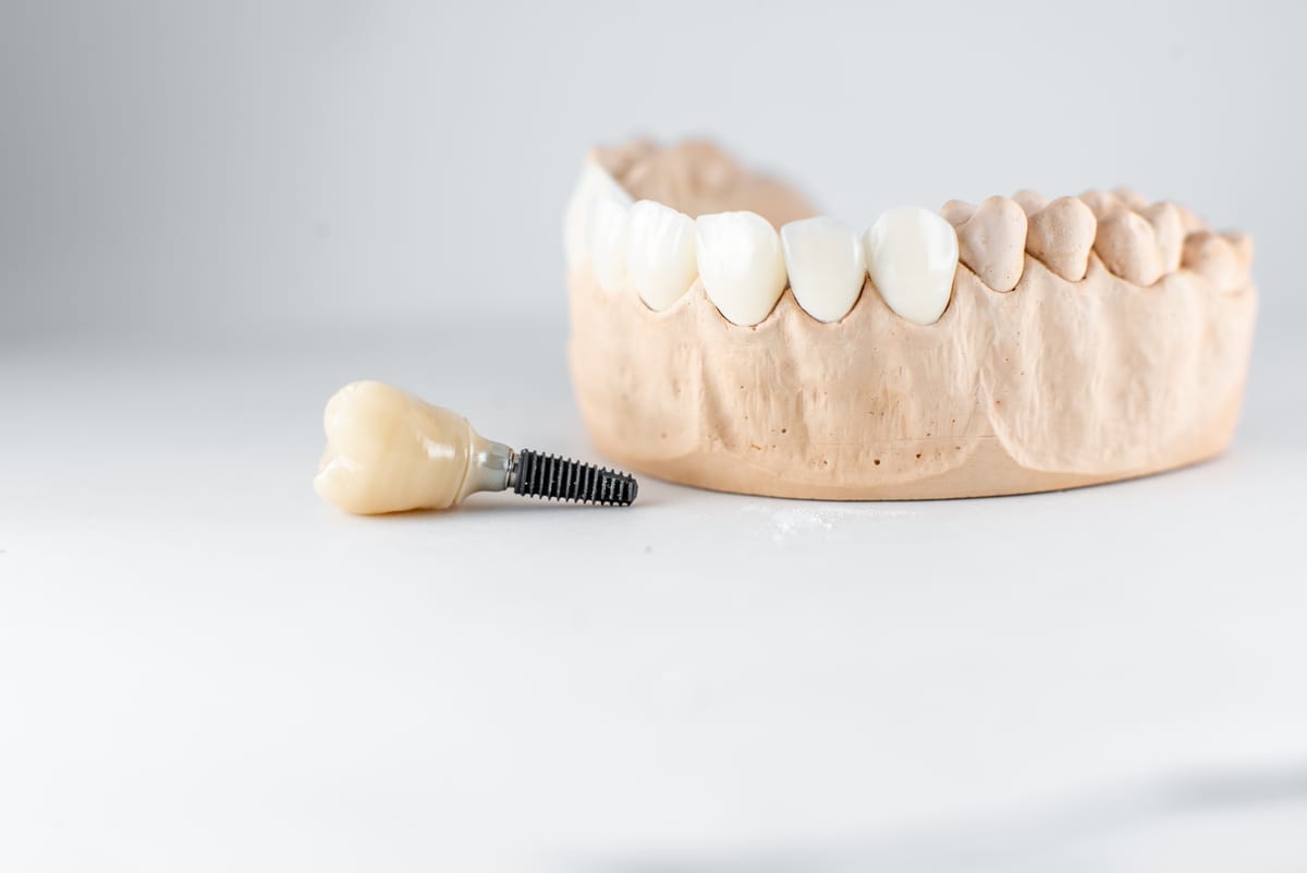 Dental Implants in Foothill Ranch